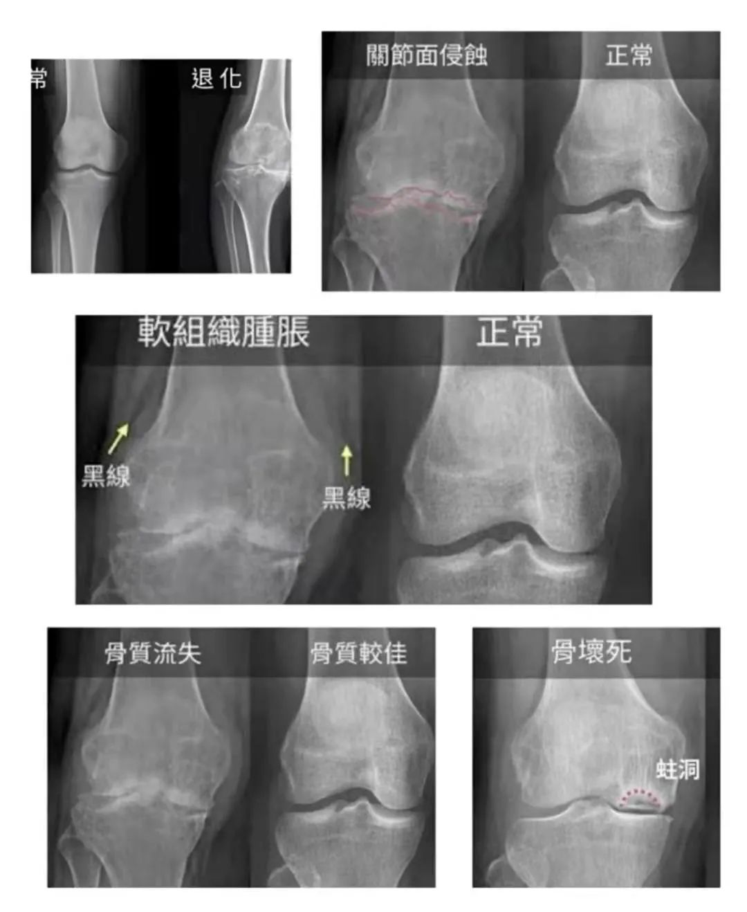 杭州普迪欣康复医院科普：膝关节炎的康复评定与治疗