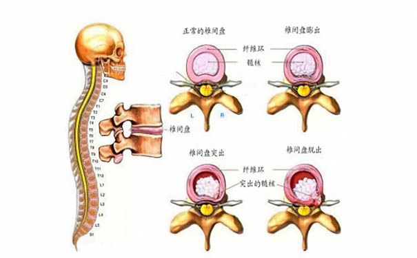 杭州博养医院科普：颈椎间盘突出是什么，如何避免颈椎间盘突出？