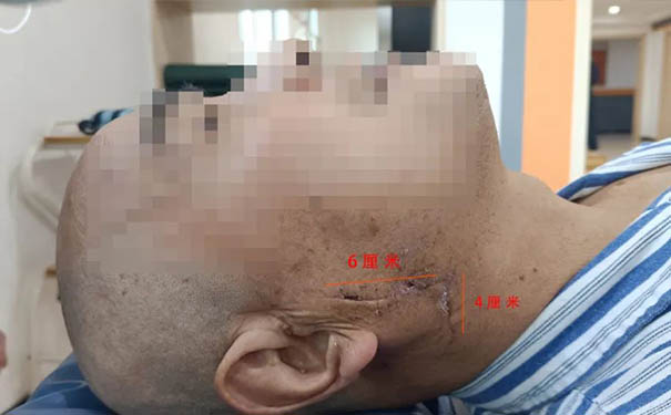 杭州普迪欣康复医院下颌骨骨折精准康复案例